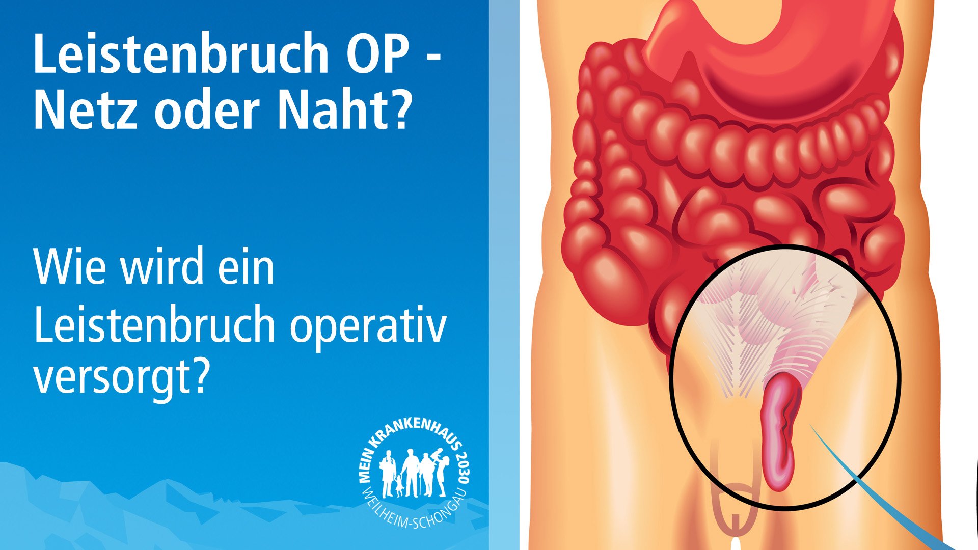 MichaelPlatz-Leistenbruchoperation2